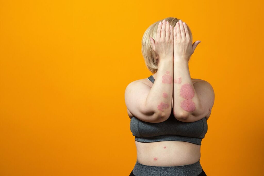 A girl hiding her face with psoriasis on her body, due to chronic inflammation.